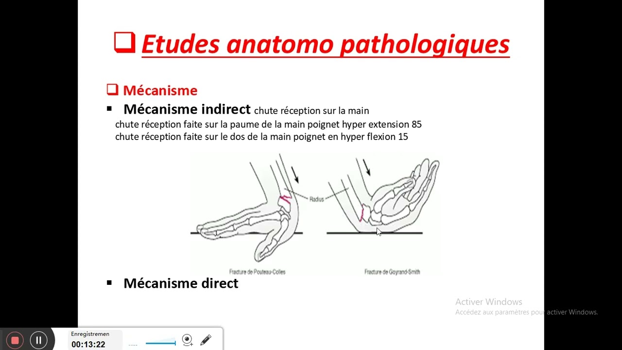 fractures de l'extrémité inférieure du radius meilleure explication par Pr MEKKI