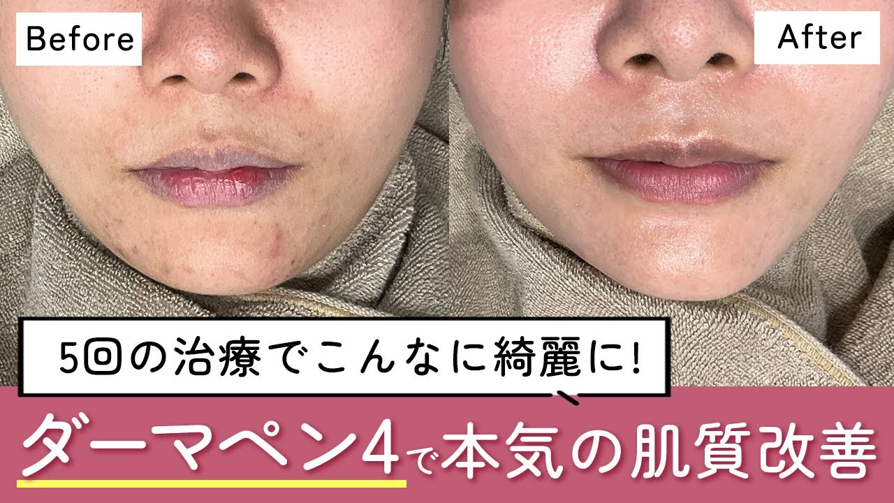 【ニキビ跡・毛穴改善】ダーマペン4で本気の美肌治療 │ ダウンタイムは？施術は何回必要？【肌質改善】