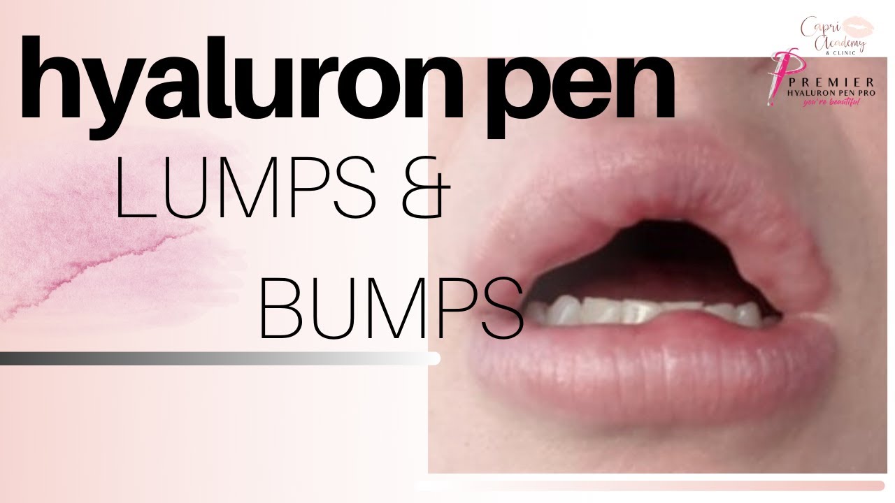 Filler Lumps and Bumps / Hyaluron Pen