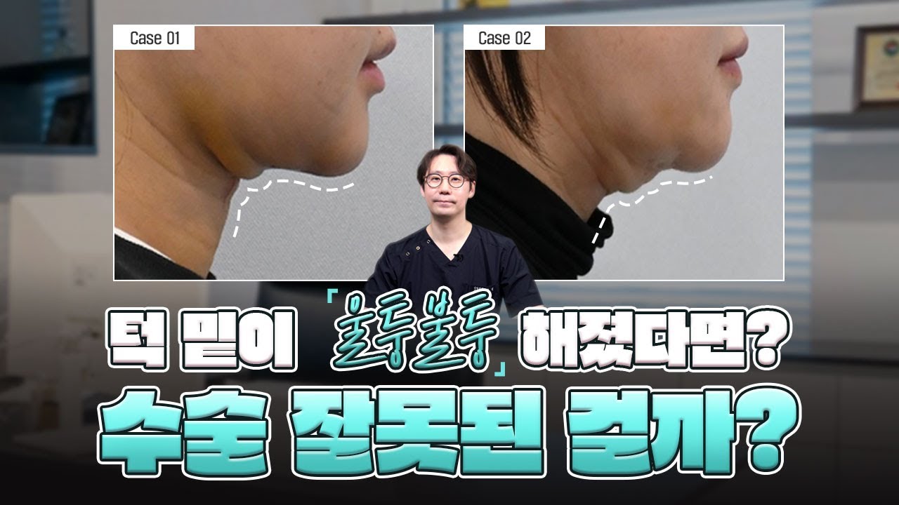 이중턱 흡입 후 턱 밑이 울퉁불퉁해졌다면? 수술 잘못된 걸까?