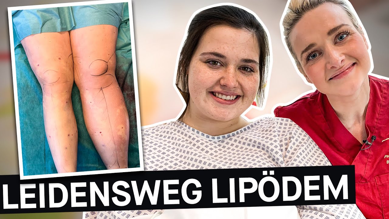 Lipödem: Jede zehnte Frau ist von der Krankheit betroffen – was ist das eigentlich || PULS Reportage