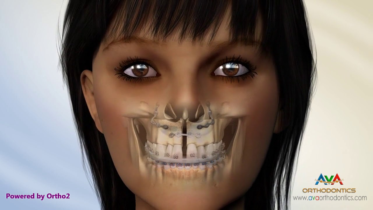 Surgical Orthodontic Treatment for Underbite or Crossbite - 2 piece Maxillary Advancement