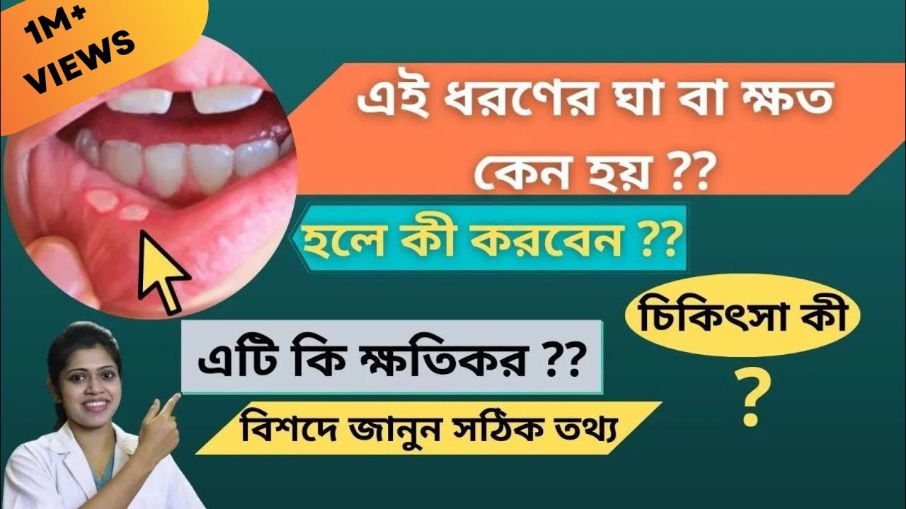 মুখে ঘা বা ক্ষত কেন হয়🔥🔥 মুখে ঘা হলে কি করবেন - Mukher Gha Saranor Upai - কিভাবে মুখের ঘা দূর করবেন