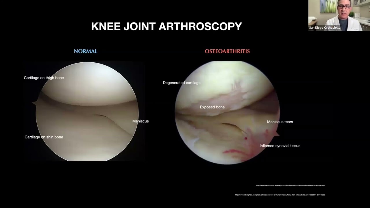 Adipose Cells to treat Knee Osteoarthritis