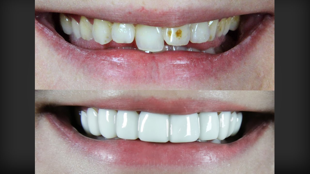 Amazing Smile Makeover - Under $1000 - Took 1 Minute - Must See