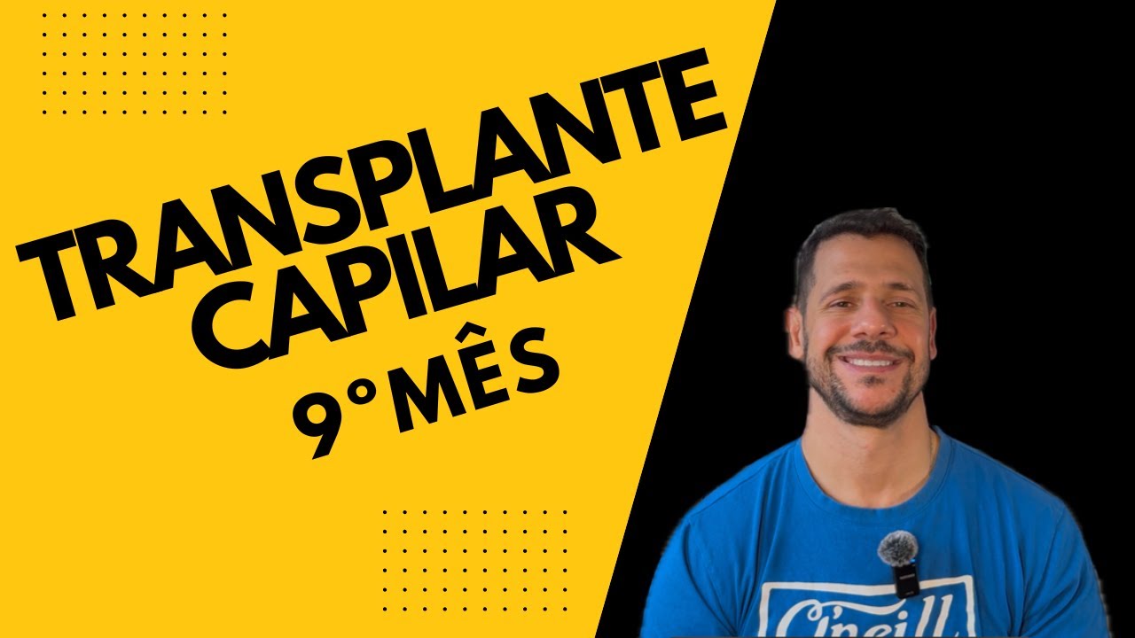 9 MESES APÓS O TRANSPLANTE CAPILAR: O RESULTADO FINAL CHEGOU?