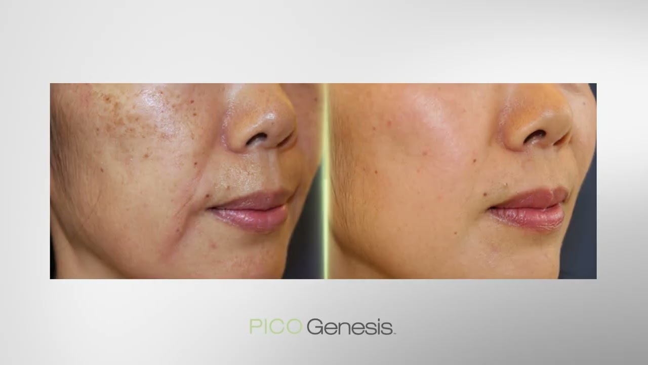 Pico Genesis behandeling Uitleg | Laser voor pigmentvlekken & huidverjonging