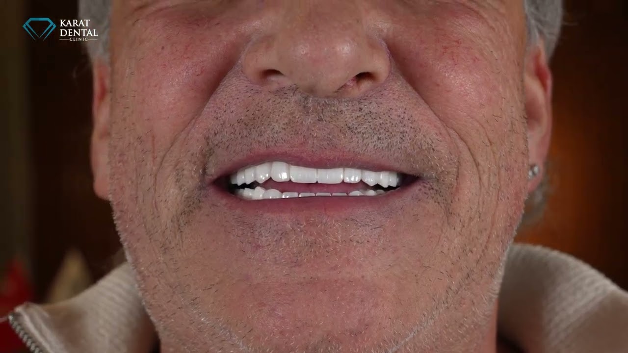 Nouveau sourire, nouvelle vie | Implants dentaires All-on-4 & All-on-6 en Turquie