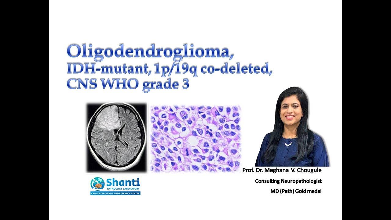 Oligodendroglioma, IDH1-mutant, 1p/19q codeleted