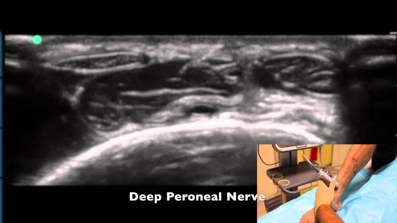 LSORA: Ankle block tutorial