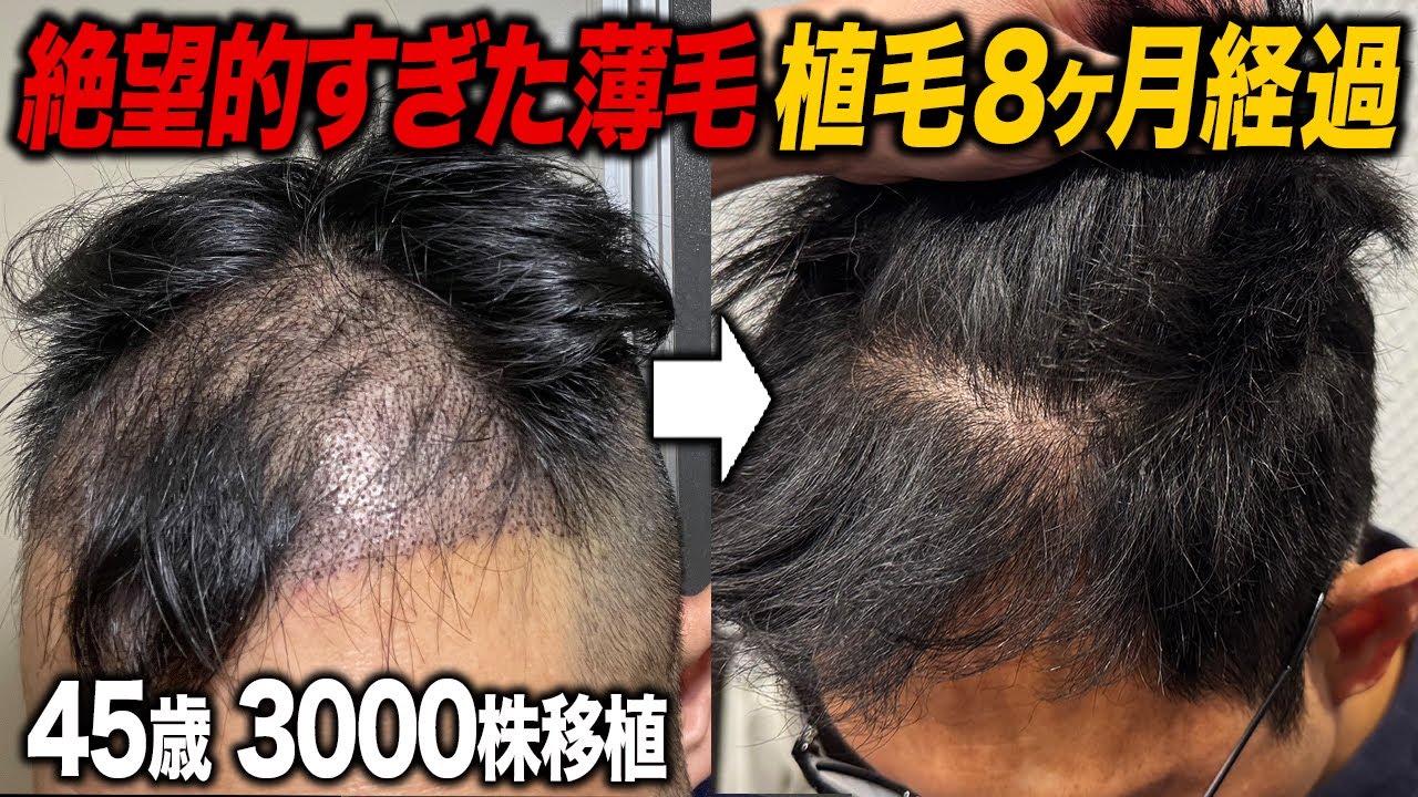 【絶望感MAX】45歳植毛8ヶ月…この結果はヤバい
