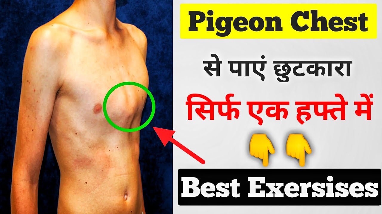 Pectus carinatum Exersises in hindi | Pigeon chest ko kaise thik kare | pigeon chest Exercise |