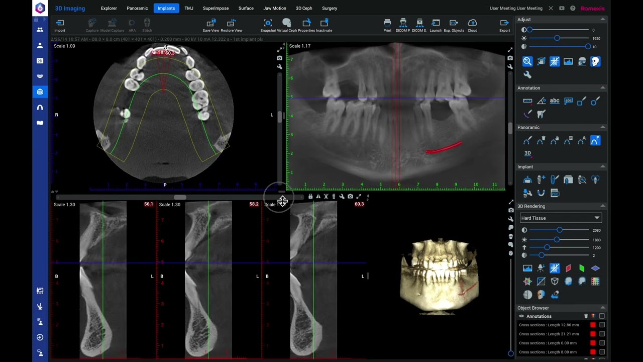 Planmeca Romexis Quick Guide for 3D Implant Planning
