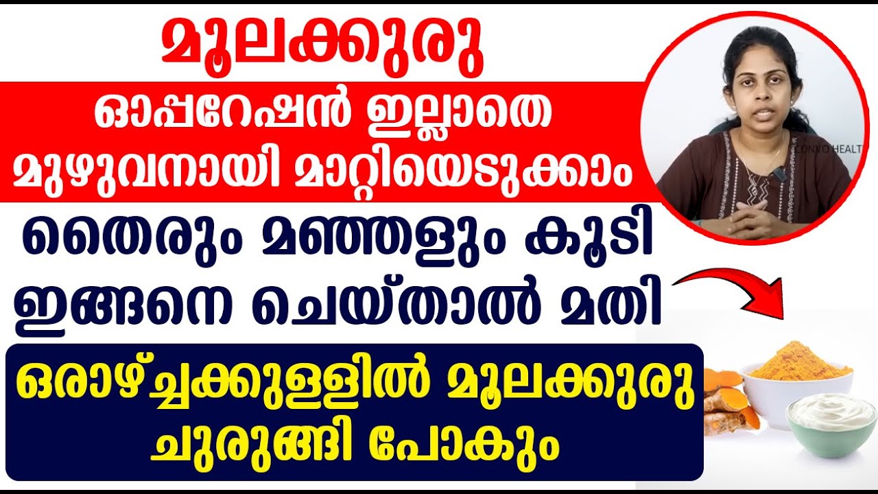 മൂലക്കുരു ഓപ്പറേഷൻ ഇല്ലാതെ മുഴുവനായി മാറ്റിയെടുക്കാം