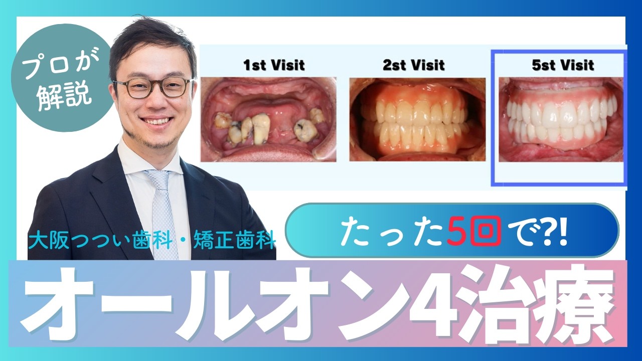 【症例解説】歯がボロボロになってしまった｡｡｡40代男性のオールオン4治療を解説