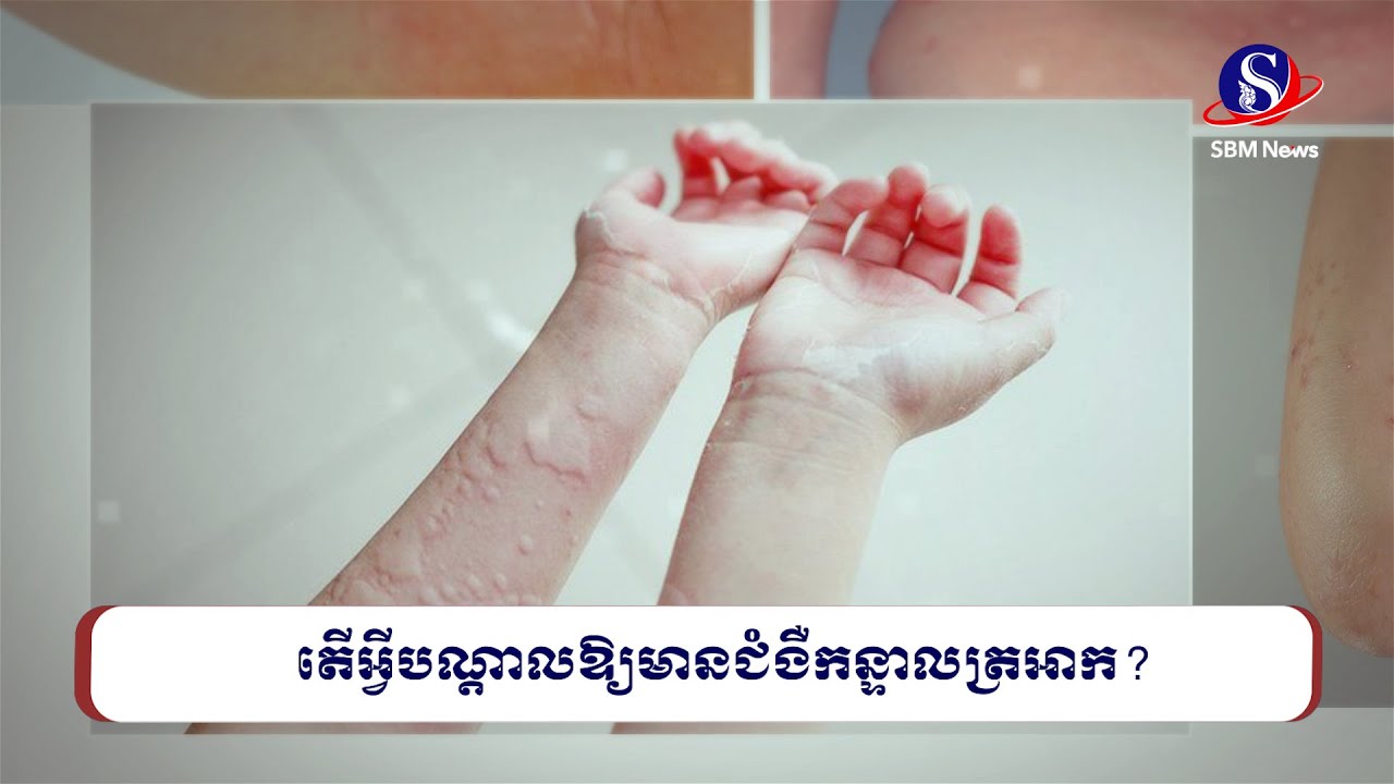 តើអ្វីបណ្តាលឱ្យមានជំងឺកន្ទាលត្រអាក? | SBM NEWS