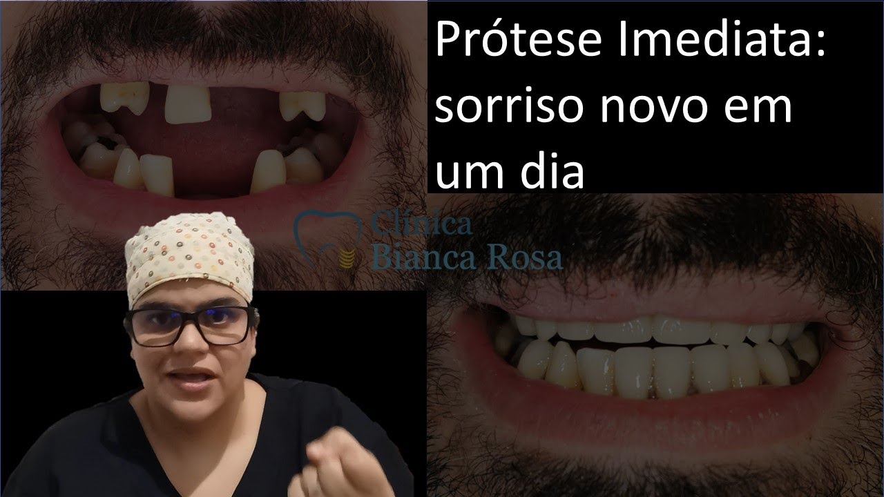 Prótese Imediata: Um novo sorriso em um dia! |Dra Bianca Rosa