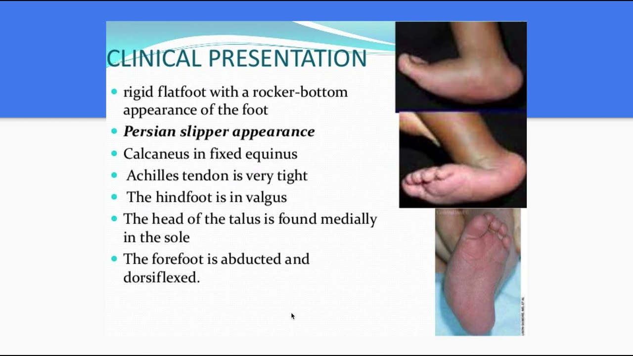 Congenital Vertical Talus for medical students
