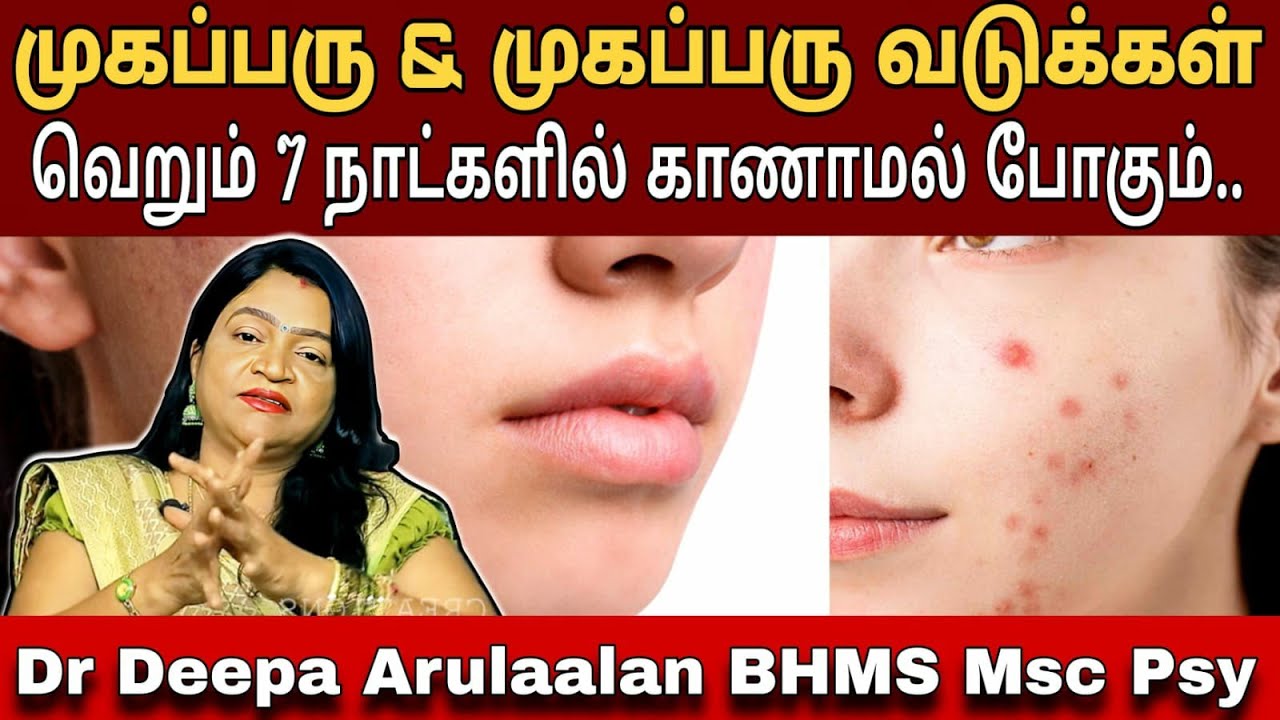 முகப்பருவினால் அவதியா?கவலைய விடுங்க | முகப்பரு & வடுக்கள் நீங்க முகத்தில் இதை பூசினால் போதும்.. #ssc