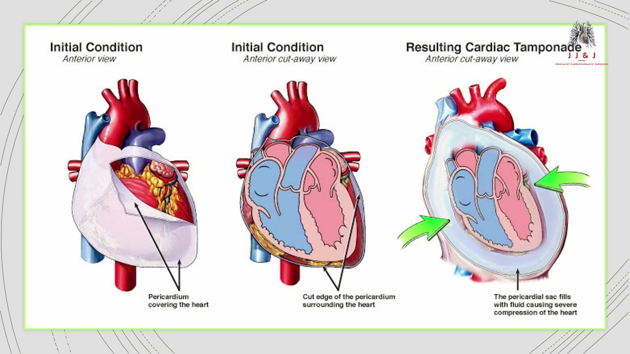 Cardiac Tamponade - Dr CY Chen