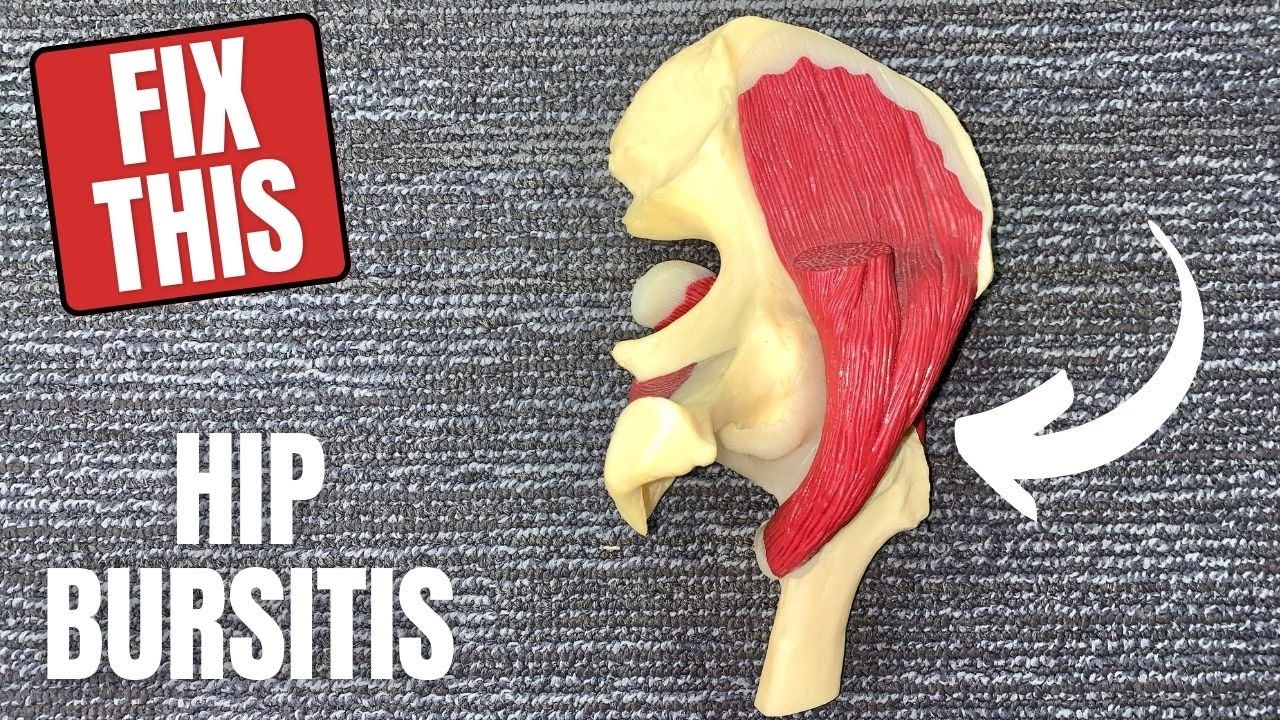 Hip Trochanteric Bursitis - What It Is, Causes, and Treatment
