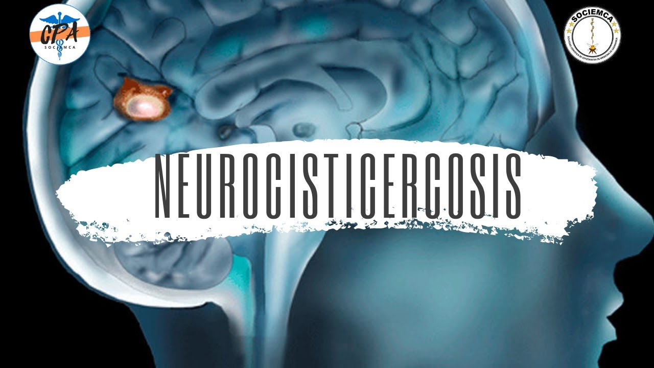 Neurocisticercosis