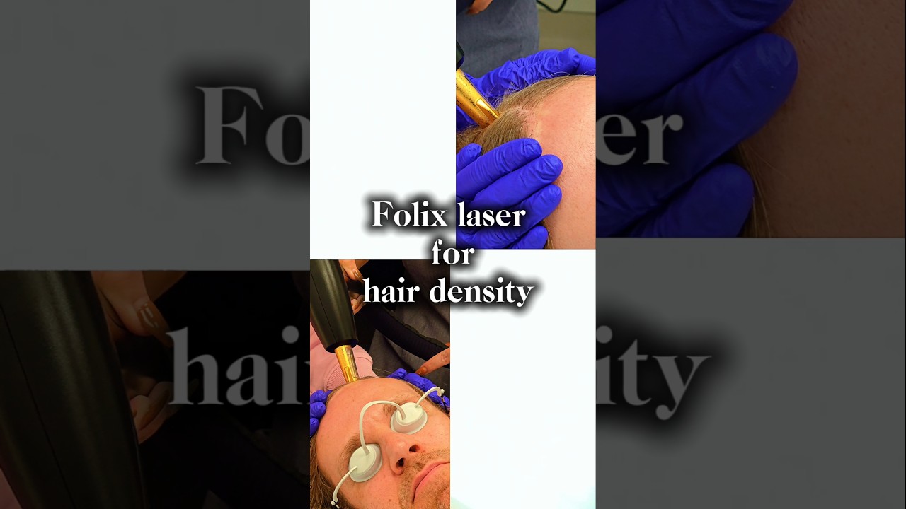Folix Fractional Laser for hair density