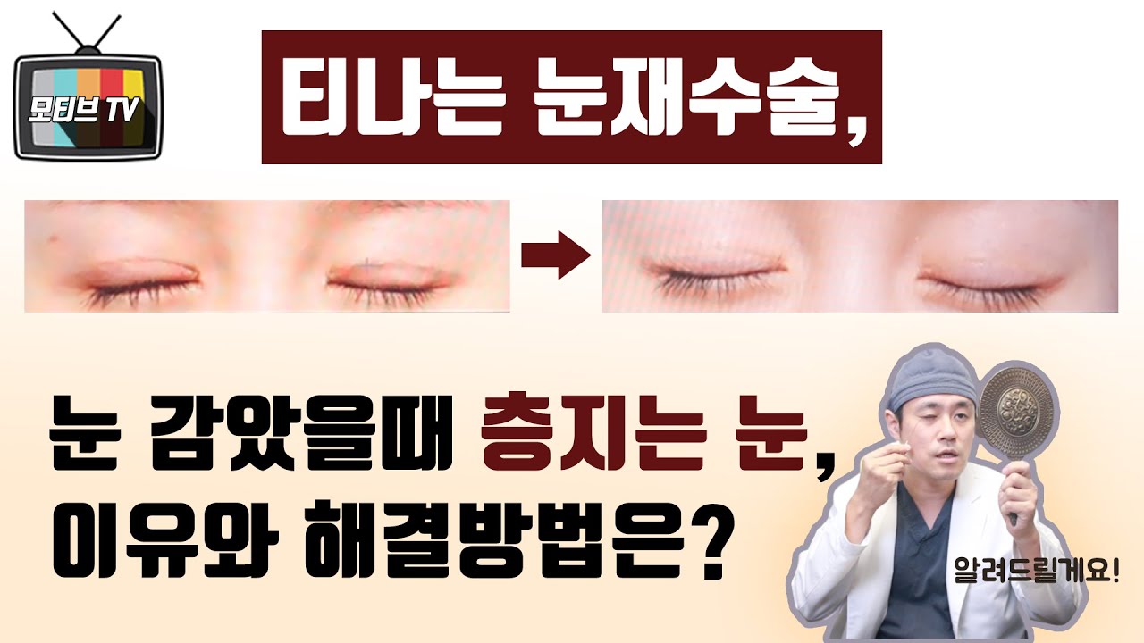[모티브 성형외과] 티나는 눈재수술, 눈 감았을 때 층지는 눈, 이유와 해결방법은?