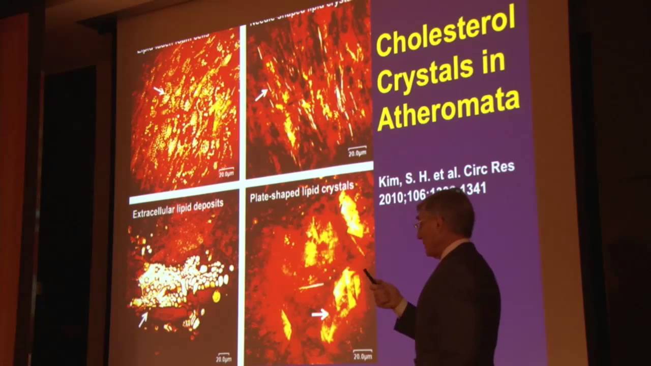 Inflammation in Atherosclerosis, Peter Libby