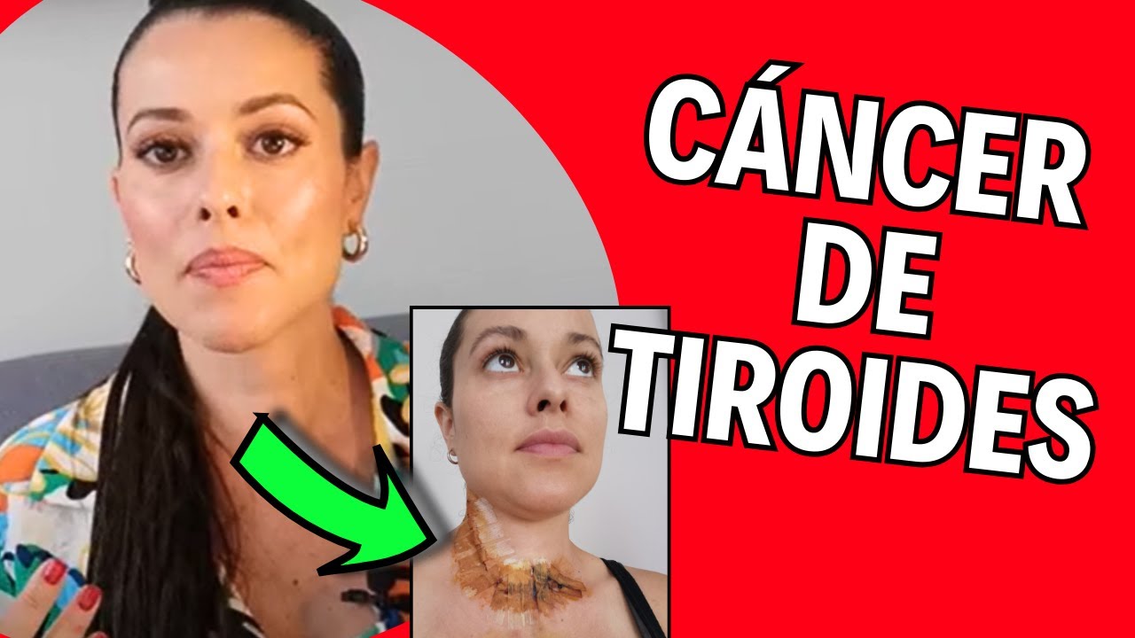 La vida Después del CÁNCER de TIROIDES : mi testimonio