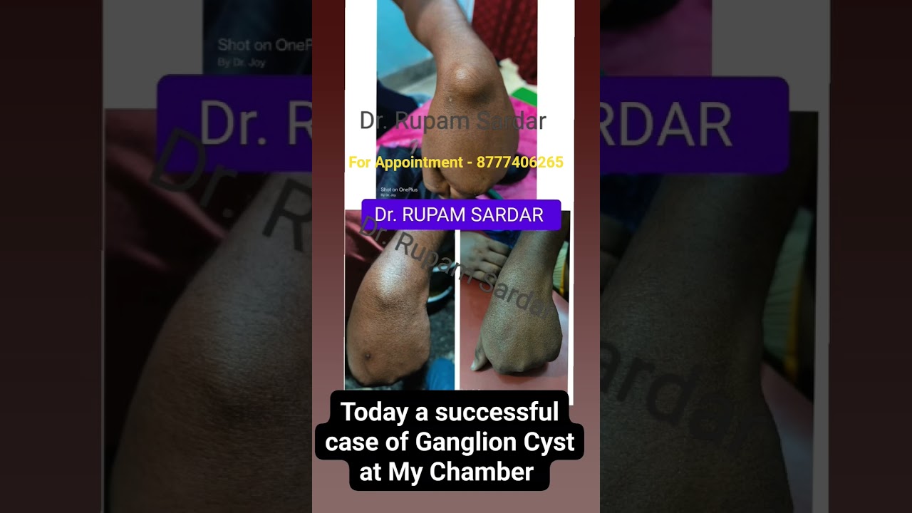 A serious case of " Ganglion Cyst" is fully cured under my treatment...For Consult- 8777406265.