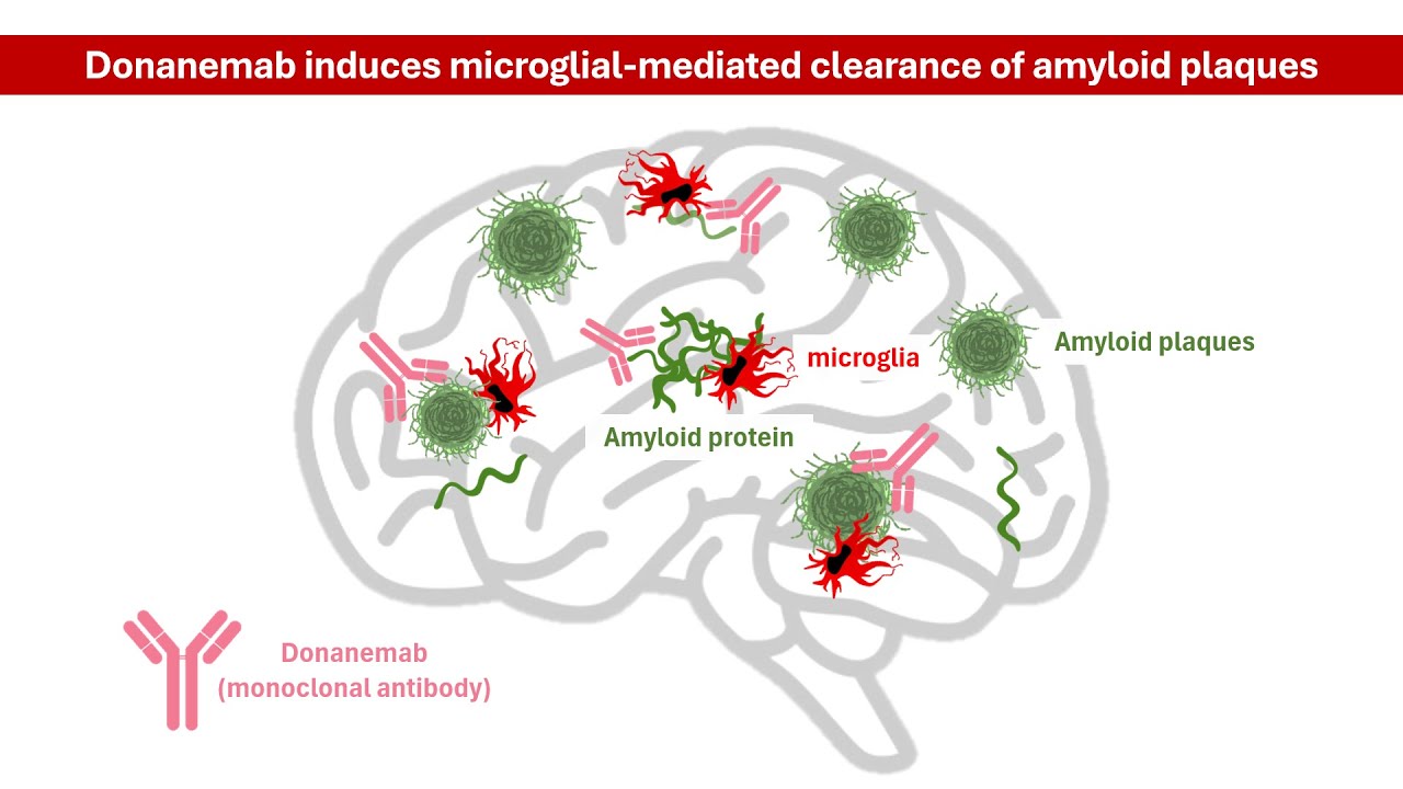 Donanemab For Alzheimer&rsquo;s: Mechanism of Action & Key Clinical Study Results Explained│ Pharmacology