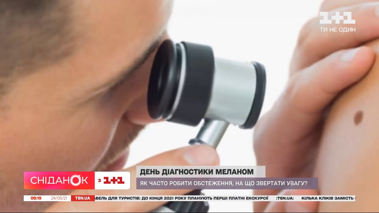 Меланома: о рисках и профилактике этого заболевания