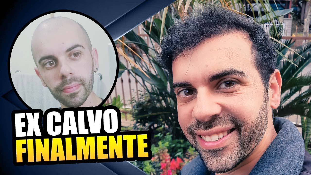 Transplante Capilar 8 meses, ninguém percebeu que já fui calvo