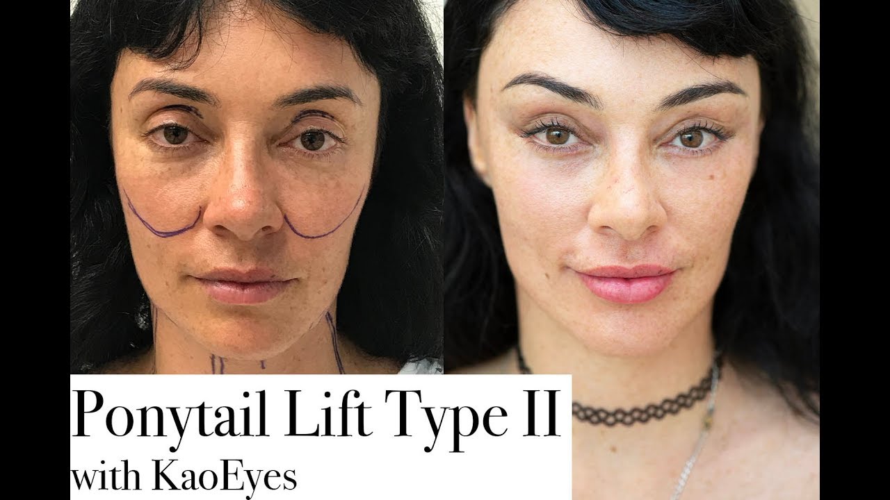 Ponytail Lift™ Type II with KaoEyes. KAO Plastic Surgery Facelift Before And After Video