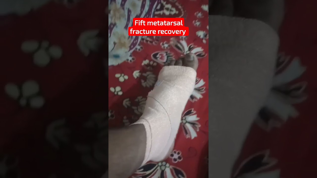 recovery time #fitness #metatarsal #stressfracture #fracture #yoga #yt_shorts #shorts