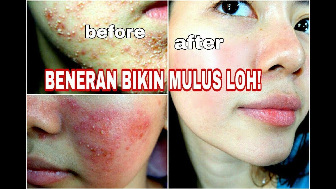 DERMAROLLER BIKIN BENGKAK DAN BERNANAH??? TUTORIAL DERMA ROLLER