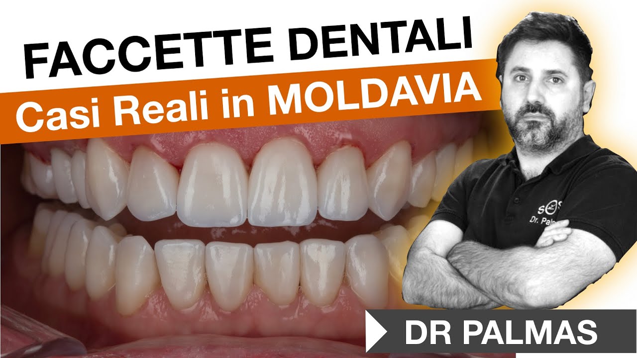 Dr Palmas 🔥Casi Reali di pazienti con faccette e corone dentali