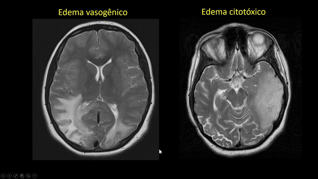 Edema cerebral