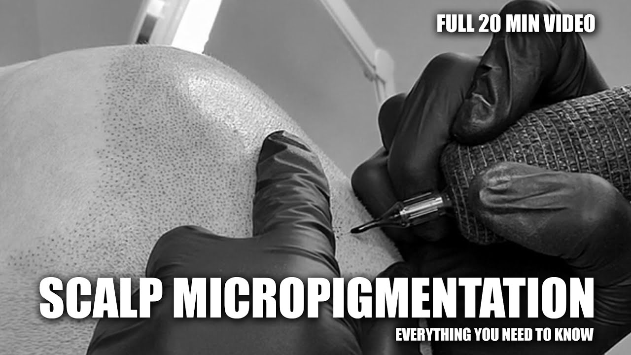 SCALP MICROPIGMENTATION - Everything You Need To Know