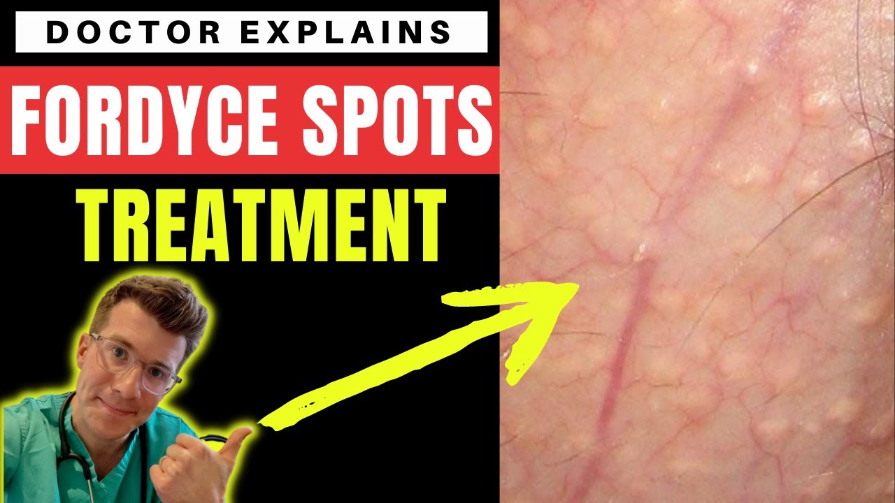 How to treat FORDYCE SPOTS - Doctor O'Donovan explains...