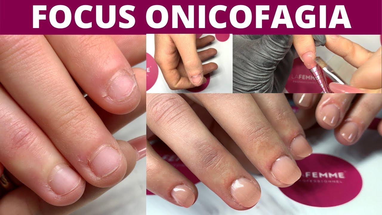 RICOSTRUZIONE SU ONICOFAGICA...3 DIVERSI METODI STEP BY STEP!