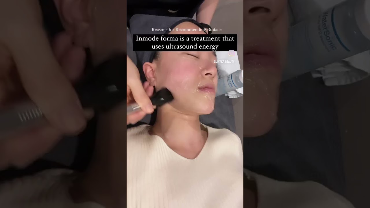 Before & After Inmode forma(at Bioface) #seoul #facelift  #kbeauty