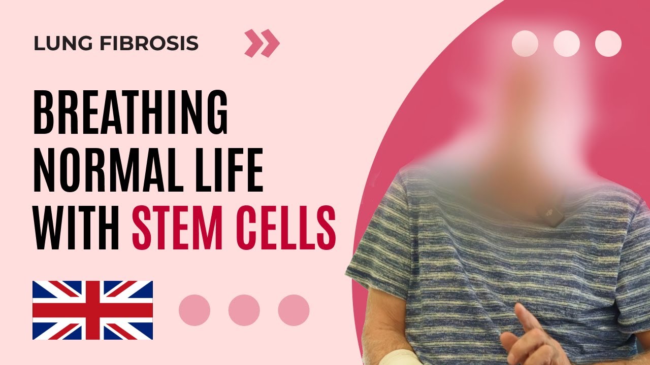 Stem Cell Therapy for Lung Fibrosis: Breath of Hope for a Patient from UK