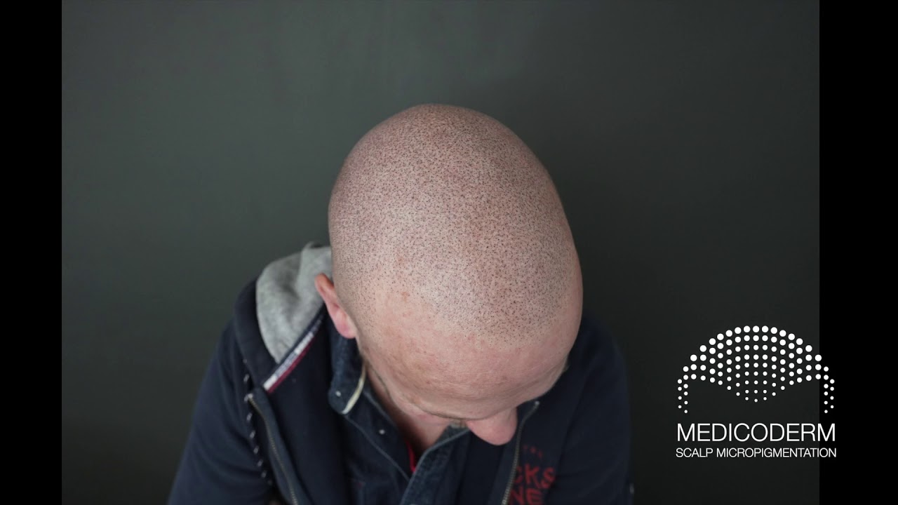#Tricopigmentation Official Song by Olivier Loin.