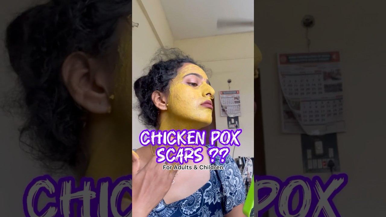 Old Chicken Pox marks bothering you..??? 