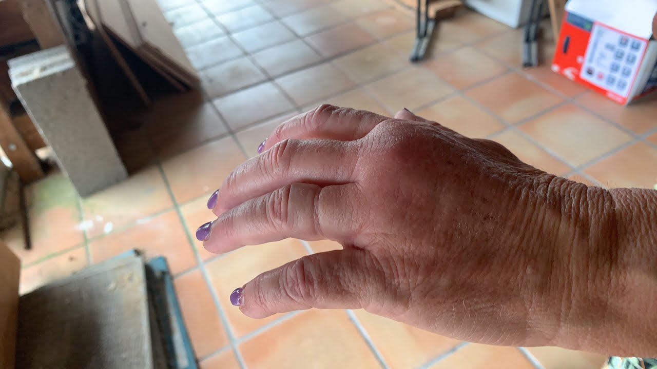 Elle s’est fait piquer par des Guêpes Polistes