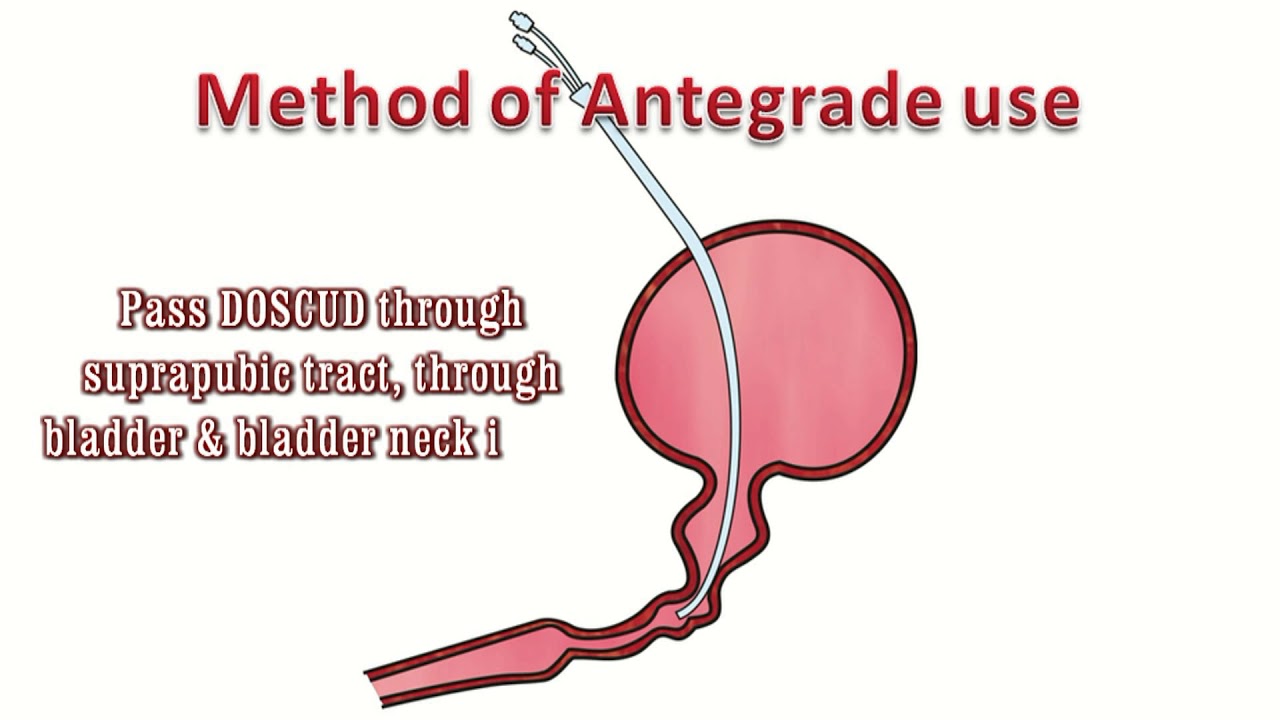 Dalela One Stage Coaxial Urethral Dilator