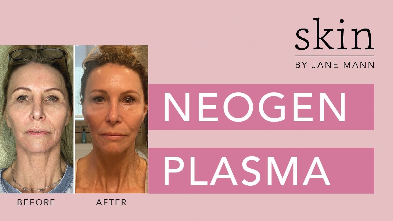My NeoGen Plasma Treatment Journey