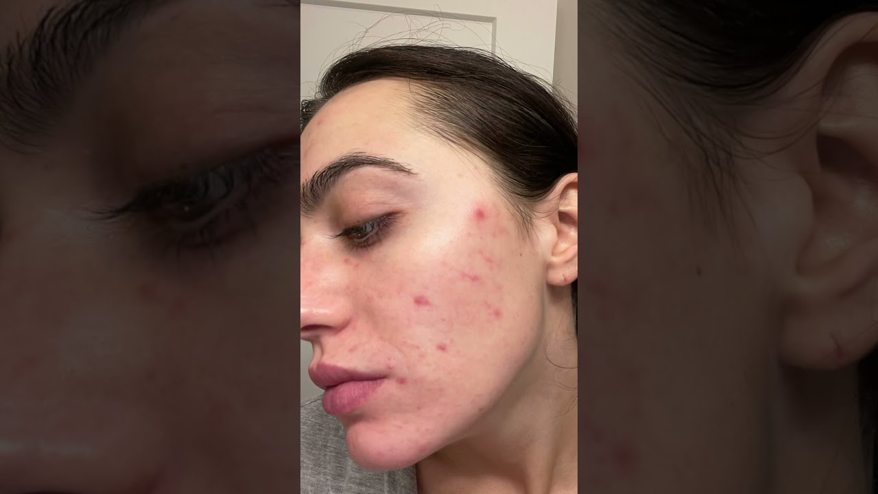 My acne journey to CLEAR skin 🙂 #shorts #acne #acneproneskin #hormonalacne #clearskin #acnejourney